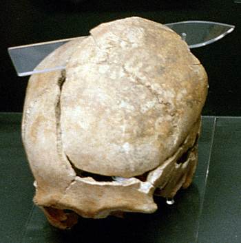 Viking-age skull removed with a sword stroke